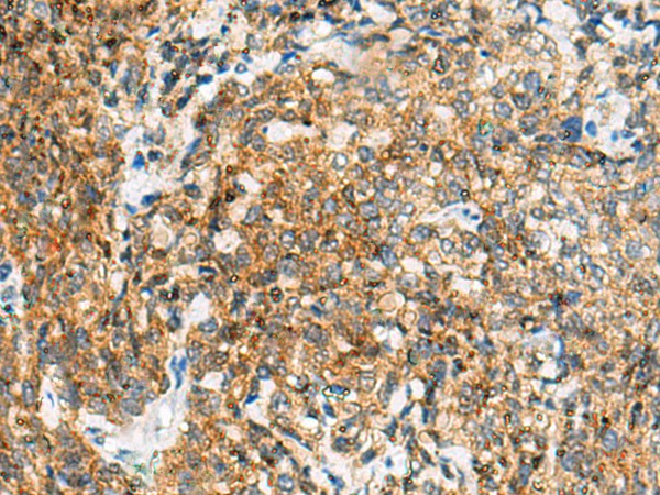 Immunohistochemistry of paraffin-embedded Human cervical cancer tissue using TUFT1 Polyclonal Antibody at dilution of 1:120(×200)