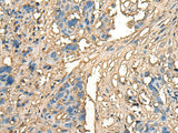 Immunohistochemistry of paraffin-embedded Human lung cancer tissue using CELA1 Polyclonal Antibody at dilution of 1:70(×200)