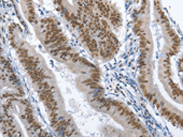 Immunohistochemistry of paraffin-embedded Human colon cancer tissue using GNRH1 Polyclonal Antibody at dilution of 1:70(×200)