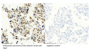 ABMIUM Free Antibody Validation – IHC-P of TBXT in paraffin-embedded human embryonal carcinoma of the anterior rectal wall using M31984-1, with negative control