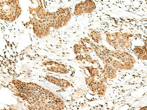 Immunohistochemistry of paraffin-embedded Human esophagus cancer tissue using RBM19 Polyclonal Antibody at dilution of 1:45(×200)
