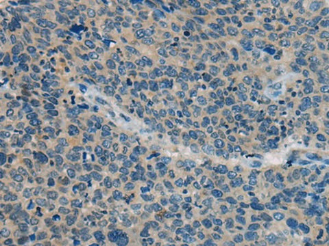 Immunohistochemistry of paraffin-embedded Human cervical cancer tissue using BACE2 Polyclonal Antibody at dilution of 1:45(×200)