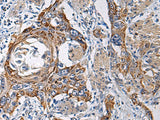 Immunohistochemistry of paraffin-embedded Human esophagus cancer tissue using RITA1 Polyclonal Antibody at dilution of 1:60(×200)