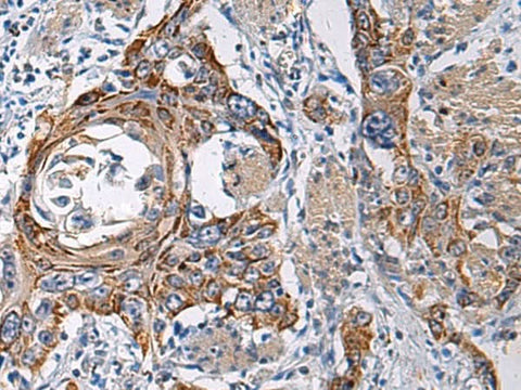 Immunohistochemistry of paraffin-embedded Human esophagus cancer tissue using RITA1 Polyclonal Antibody at dilution of 1:60(×200)