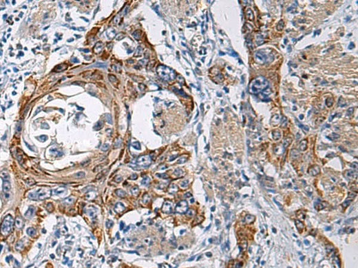 Immunohistochemistry of paraffin-embedded Human esophagus cancer tissue using RITA1 Polyclonal Antibody at dilution of 1:60(×200)