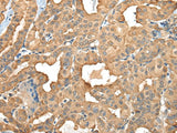 Immunohistochemistry of paraffin-embedded Human thyroid cancer tissue using C1GALT1C1 Polyclonal Antibody at dilution of 1:45(×200)