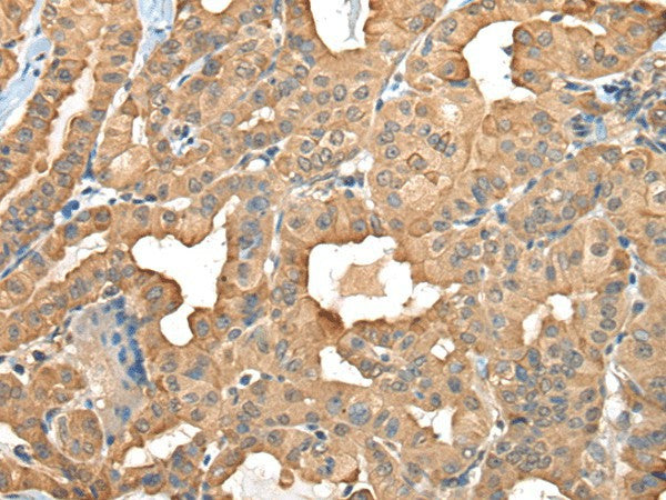 Immunohistochemistry of paraffin-embedded Human thyroid cancer tissue using C1GALT1C1 Polyclonal Antibody at dilution of 1:45(×200)