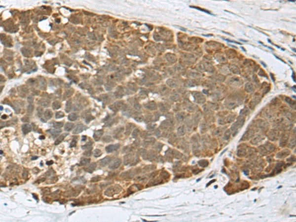 Immunohistochemistry of paraffin-embedded Human thyroid cancer tissue using SPRTN Polyclonal Antibody at dilution of 1:65(×200)