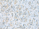 Immunohistochemistry of paraffin-embedded Human liver cancer tissue using PLN Polyclonal Antibody at dilution of 1:45(×200)