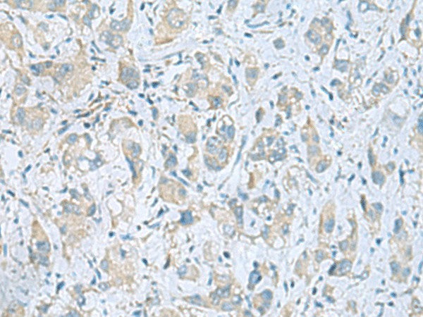 Immunohistochemistry of paraffin-embedded Human liver cancer tissue using PLN Polyclonal Antibody at dilution of 1:45(×200)