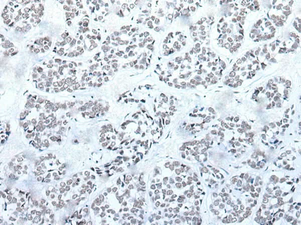 Immunohistochemistry of paraffin-embedded Human esophagus cancer tissue using BRD3 Polyclonal Antibody at dilution of 1:60(×200)