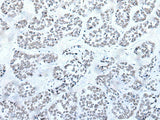 Immunohistochemistry of paraffin-embedded Human esophagus cancer tissue using BRD3 Polyclonal Antibody at dilution of 1:60(×200)