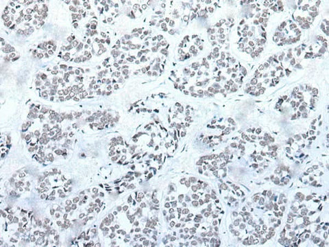 Immunohistochemistry of paraffin-embedded Human esophagus cancer tissue using BRD3 Polyclonal Antibody at dilution of 1:60(×200)