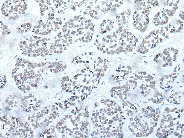 Immunohistochemistry of paraffin-embedded Human esophagus cancer tissue using BRD3 Polyclonal Antibody at dilution of 1:60(×200)
