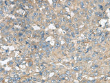 Immunohistochemistry of paraffin-embedded Human liver cancer tissue using CXCR5 Polyclonal Antibody at dilution of 1:80(×200)