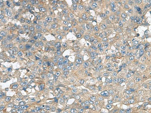 Immunohistochemistry of paraffin-embedded Human liver cancer tissue using CXCR5 Polyclonal Antibody at dilution of 1:80(×200)