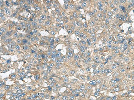 Immunohistochemistry of paraffin-embedded Human liver cancer tissue using CXCR5 Polyclonal Antibody at dilution of 1:80(×200)