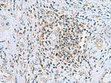 Immunohistochemistry of paraffin-embedded Human liver cancer tissue using DHRS7B Polyclonal Antibody at dilution of 1:80(×200)