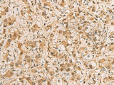 Immunohistochemistry of paraffin-embedded Human liver cancer tissue using PDXK Polyclonal Antibody at dilution of 1:75(×200)