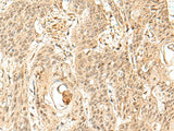 Immunohistochemistry of paraffin-embedded Human esophagus cancer tissue using SNAPC5 Polyclonal Antibody at dilution of 1:30(×200)