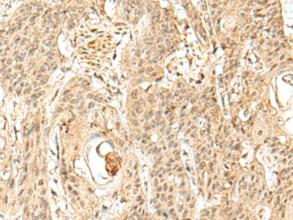 Immunohistochemistry of paraffin-embedded Human esophagus cancer tissue using SNAPC5 Polyclonal Antibody at dilution of 1:30(×200)
