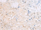 Immunohistochemistry of paraffin-embedded Human gastric cancer tissue using DPCD Polyclonal Antibody at dilution of 1:50(×200)