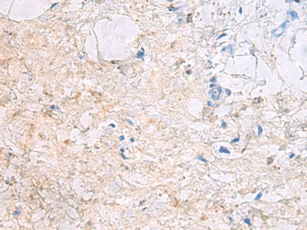 Immunohistochemistry of paraffin-embedded Human gastric cancer tissue using DPCD Polyclonal Antibody at dilution of 1:50(×200)