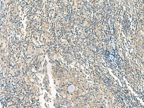 Immunohistochemistry of paraffin-embedded Human tonsil tissue using HASPIN Polyclonal Antibody at dilution of 1:45(×200)