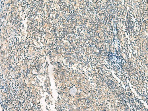 Immunohistochemistry of paraffin-embedded Human tonsil tissue using HASPIN Polyclonal Antibody at dilution of 1:45(×200)