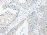 Immunohistochemistry of paraffin-embedded Human colorectal cancer tissue using GPRASP2 Polyclonal Antibody at dilution of 1:75(×200)