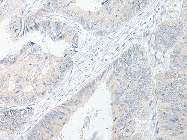 Immunohistochemistry of paraffin-embedded Human colorectal cancer tissue using GPRASP2 Polyclonal Antibody at dilution of 1:75(×200)