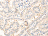 Immunohistochemistry of paraffin-embedded Human thyroid cancer tissue using RADIL Polyclonal Antibody at dilution of 1:30(×200)