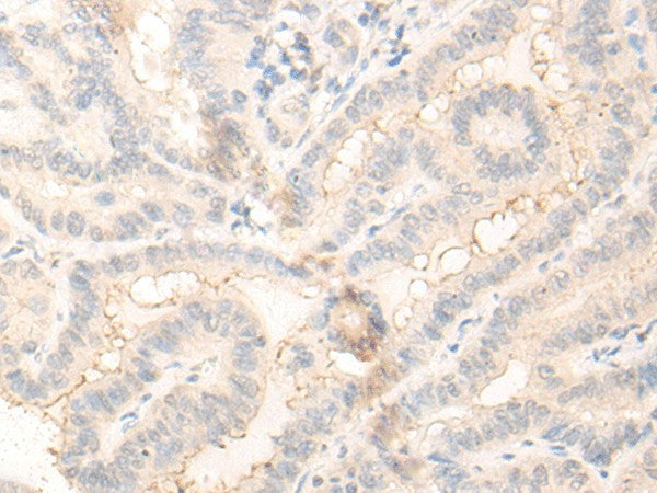 Immunohistochemistry of paraffin-embedded Human thyroid cancer tissue using RADIL Polyclonal Antibody at dilution of 1:30(×200)