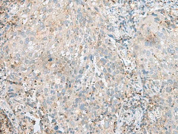 Immunohistochemistry of paraffin-embedded Human cervical cancer tissue using SEPT1 Polyclonal Antibody at dilution of 1:60(×200)