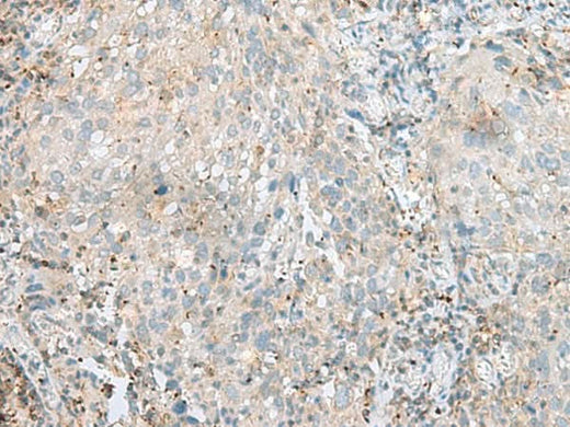 Immunohistochemistry of paraffin-embedded Human cervical cancer tissue using SEPT1 Polyclonal Antibody at dilution of 1:60(×200)