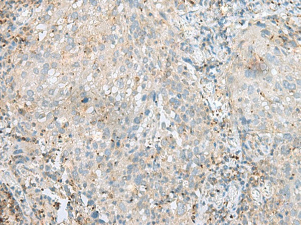 Immunohistochemistry of paraffin-embedded Human cervical cancer tissue using SEPT1 Polyclonal Antibody at dilution of 1:60(×200)