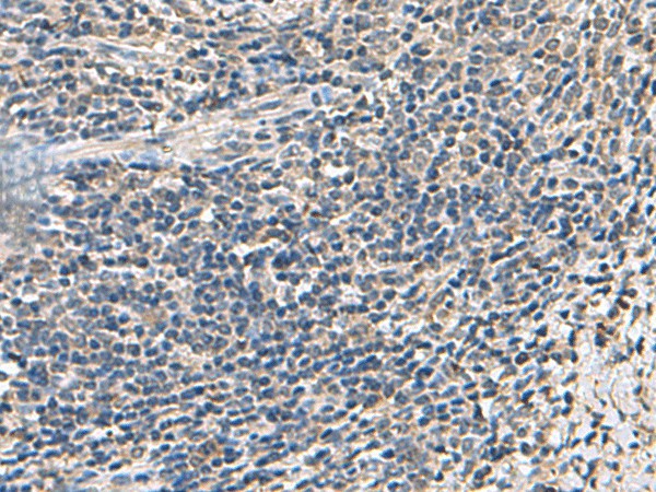 Immunohistochemistry of paraffin-embedded Human cervical cancer tissue using ATP5F1D Polyclonal Antibody at dilution of 1:55(×200)