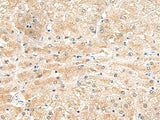 Immunohistochemistry of paraffin-embedded Human liver cancer tissue using LRG1 Polyclonal Antibody at dilution of 1:50(×200)