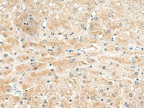Immunohistochemistry of paraffin-embedded Human liver cancer tissue using LRG1 Polyclonal Antibody at dilution of 1:50(×200)
