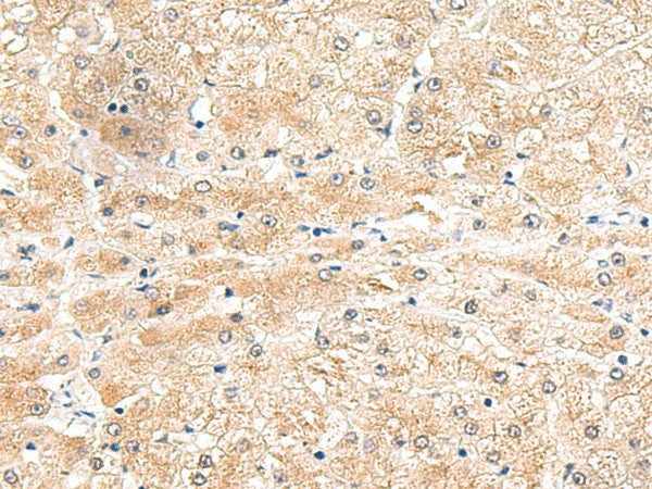 Immunohistochemistry of paraffin-embedded Human liver cancer tissue using LRG1 Polyclonal Antibody at dilution of 1:50(×200)