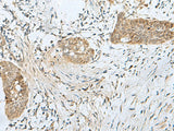 Immunohistochemistry of paraffin-embedded Human esophagus cancer tissue using SNRPD1 Polyclonal Antibody at dilution of 1:70(×200)