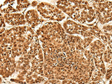 Immunohistochemistry of paraffin-embedded Human esophagus cancer tissue using NEK7 Polyclonal Antibody at dilution of 1:60(×200)