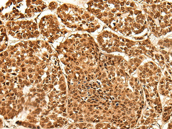 Immunohistochemistry of paraffin-embedded Human esophagus cancer tissue using NEK7 Polyclonal Antibody at dilution of 1:60(×200)