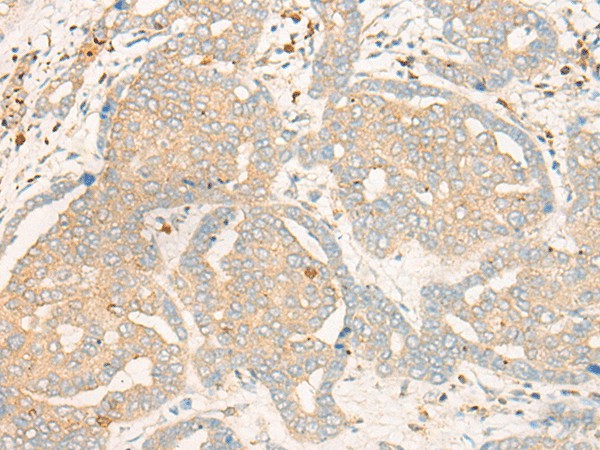 Immunohistochemistry of paraffin-embedded Human liver cancer tissue using FBXO32 Polyclonal Antibody at dilution of 1:35(×200)