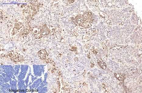 Immunohistochemistry of paraffin-embedded Human lung cancer tissue using CD15 Monoclonal Antibody at dilution of 1:200.