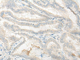 Immunohistochemistry of paraffin-embedded Human thyroid cancer tissue using DNASE1L1 Polyclonal Antibody at dilution of 1:25(×200)