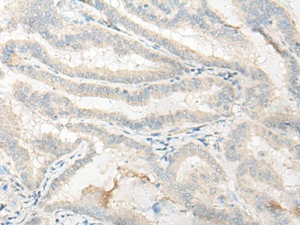 Immunohistochemistry of paraffin-embedded Human thyroid cancer tissue using DNASE1L1 Polyclonal Antibody at dilution of 1:25(×200)