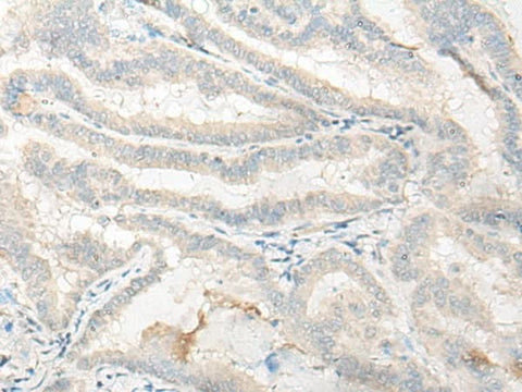 Immunohistochemistry of paraffin-embedded Human thyroid cancer tissue using DNASE1L1 Polyclonal Antibody at dilution of 1:25(×200)