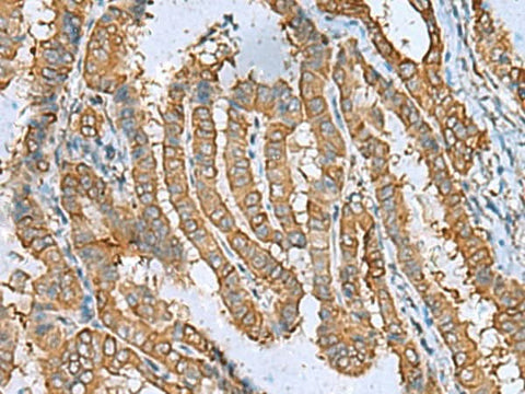 Immunohistochemistry of paraffin-embedded Human thyroid cancer tissue using DPYSL3 Polyclonal Antibody at dilution of 1:55(×200)