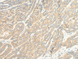 Immunohistochemistry of paraffin-embedded Human liver cancer tissue using TTC4 Polyclonal Antibody at dilution of 1:45(×200)